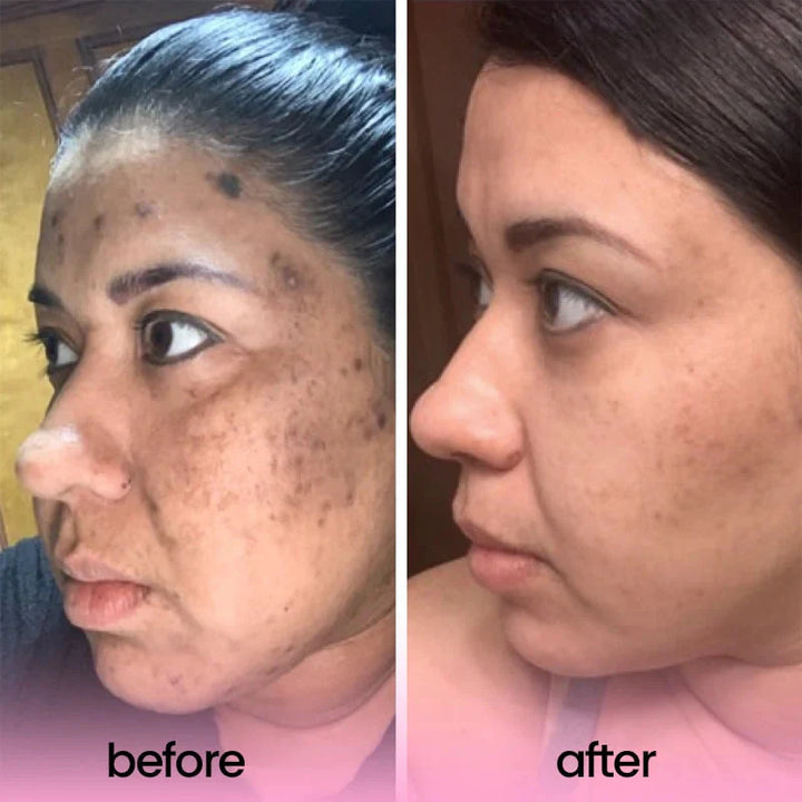 Translation missing: en.TURMERIC &amp; KOJIC ACID PADS